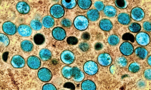 Monkeypox virus